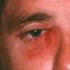 涙嚢炎は涙が止まらなくなる？その症状や種類、原因について知ろう！