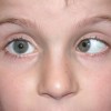 斜視の治し方とは？原因や症状、検査方法も紹介！