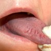 舌が割れるのは体調不良のサイン？４つの原因と対処方法