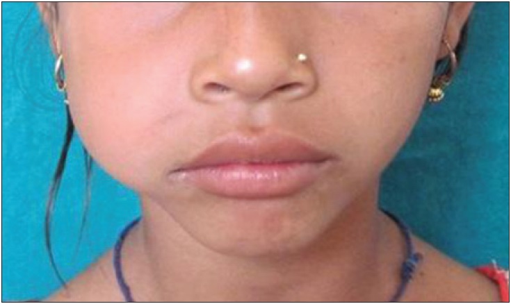 顔が腫れるのは病気 考えられる原因と症状を知っておこう Hapila ハピラ