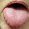 舌のむくみの２つの原因とは？改善する方法と症状を知っておこう！