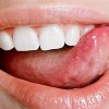舌痛症とは？原因・症状・治療法について詳しく紹介！