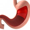 スキルス胃がんの症状とは？特徴や原因、治療方法を紹介！