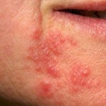 口囲皮膚炎とは？症状や原因、治療方法を知って予防しよう！