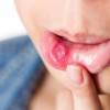 ベーチェット病ってなに？症状や原因、治療方法を知ろう！ただの口内炎に要注意？