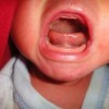舌小帯短縮症とは？症状や治療方法、手術についてを紹介！