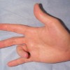 ばね指の治し方とは？原因や症状、手術の方法を知ろう！