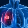 肺腫瘍の良性、悪性の違いを知ろう！症状や原因、治療するための手術方法などを紹介！