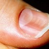 スプーン爪ってどんな爪？症状や原因、治療方法を詳しく知ろう！