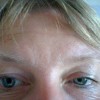 ホルネル症候群とは？症状や原因、治療法を知ろう！瞳孔の変化で病気に気づける？