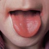舌炎の原因や治し方はなに？種類と症状を把握しよう！口内炎との違いを紹介！