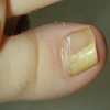 爪甲剥離症は治るの？治療法や原因、症状について詳しく知ろう！