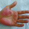 手掌紅斑の原因とは？症状や発生の仕組みを知ろう！かゆみが判断基準になる？治療方法も紹介！