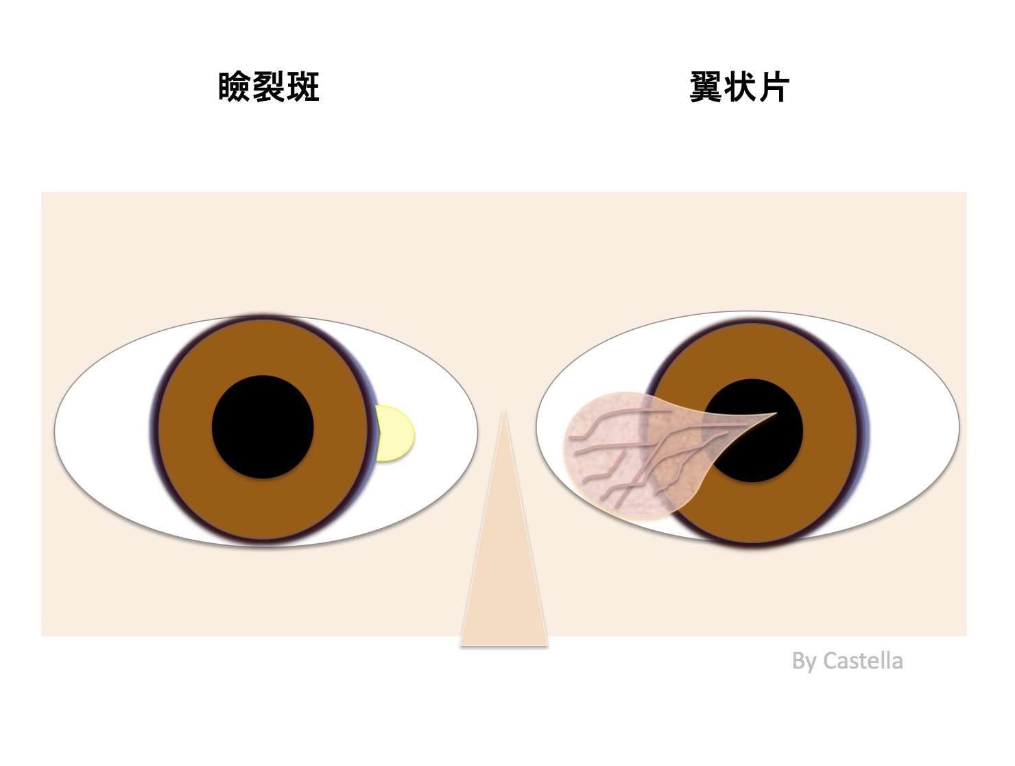 瞼裂斑は治療する必要がある？症状や原因、予防方法も紹介！鼻側に多い理由は？ | Hapila [ハピラ]