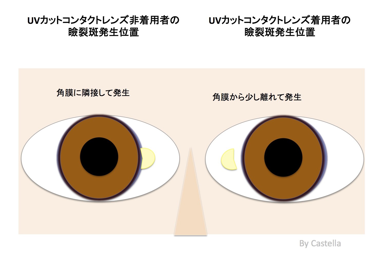 瞼裂斑は治療する必要がある？症状や原因、予防方法も紹介！鼻側に多い理由は？ | Hapila [ハピラ]