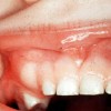 歯牙腫は放置すると危ない？その理由や治療法を知ろう！症状や原因も紹介！