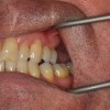奥歯の歯茎が痛い！原因や症状、病気の可能性を紹介！親知らずが生えてるのかも？