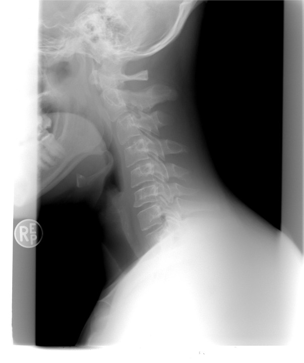 cervical-spine-1129431_960_720