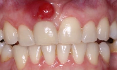 歯茎にできものが出来る原因とは 病気の可能性や口内炎について紹介 Hapila ハピラ