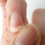 二枚爪の原因と治し方を紹介！二枚爪が発生しやすい病気とは？