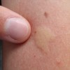 蚊に刺されて腫れるメカニズムは？体の反応や対処法、治療方法を紹介！