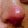 鼻が腫れる原因はなに？可能性のある病気や出来物などを紹介！