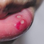口内炎が白いのは何？口内炎の種類や原因を知ろう！関係する病気も紹介！
