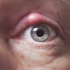 眼瞼炎とは？症状や原因、治療法を知ろう！目を擦るの行為に要注意！