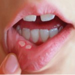 カタル性口内炎とは？症状や原因、治療方法を知ろう！他の口内炎との違いは？