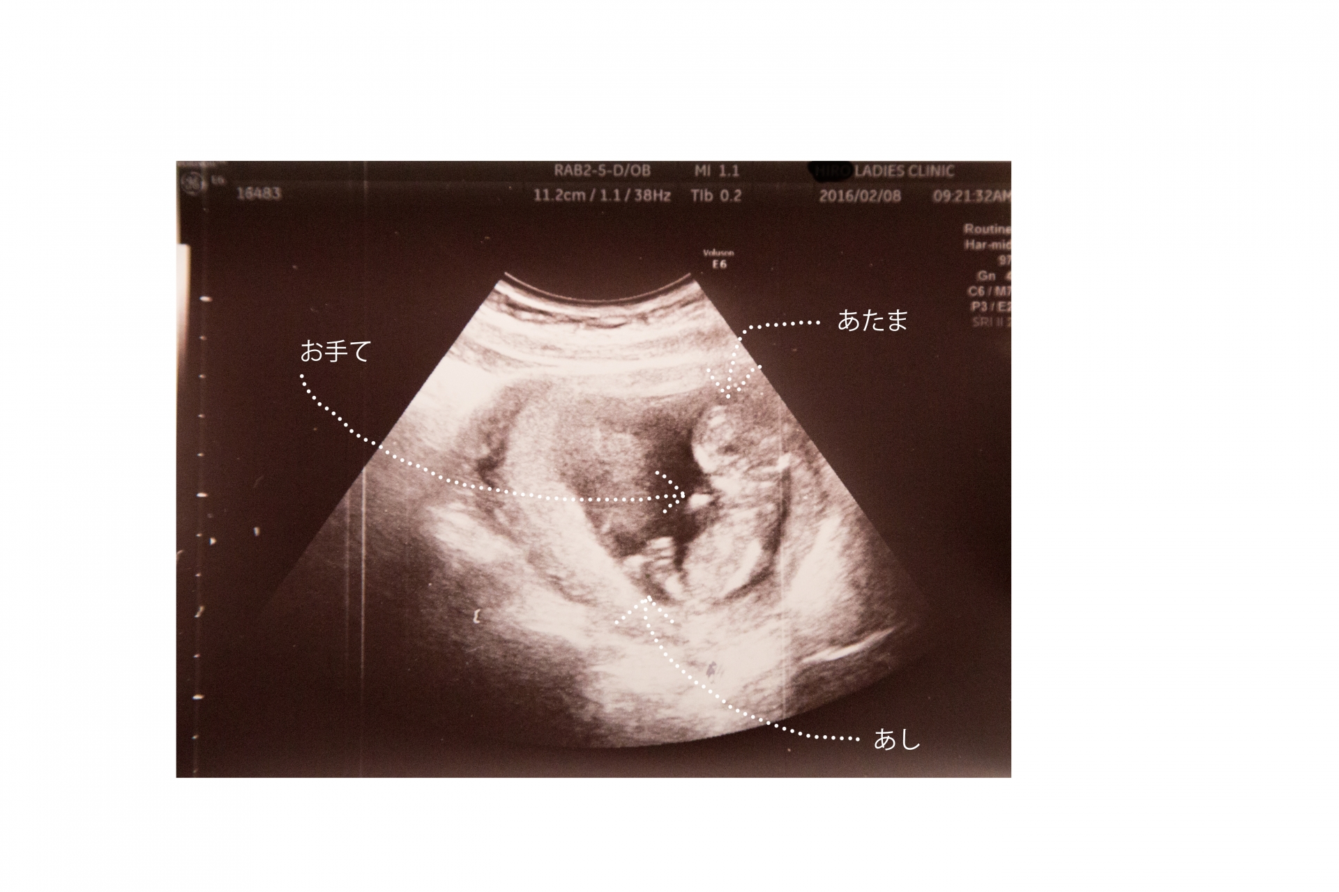 胎児の写真