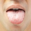 舌が荒れるのは病気？考えられる原因と症状、対処方法を知ろう！
