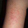 腕に赤い斑点が出来るのは病気？かゆみがある場合とない場合で分かる原因を知ろう！