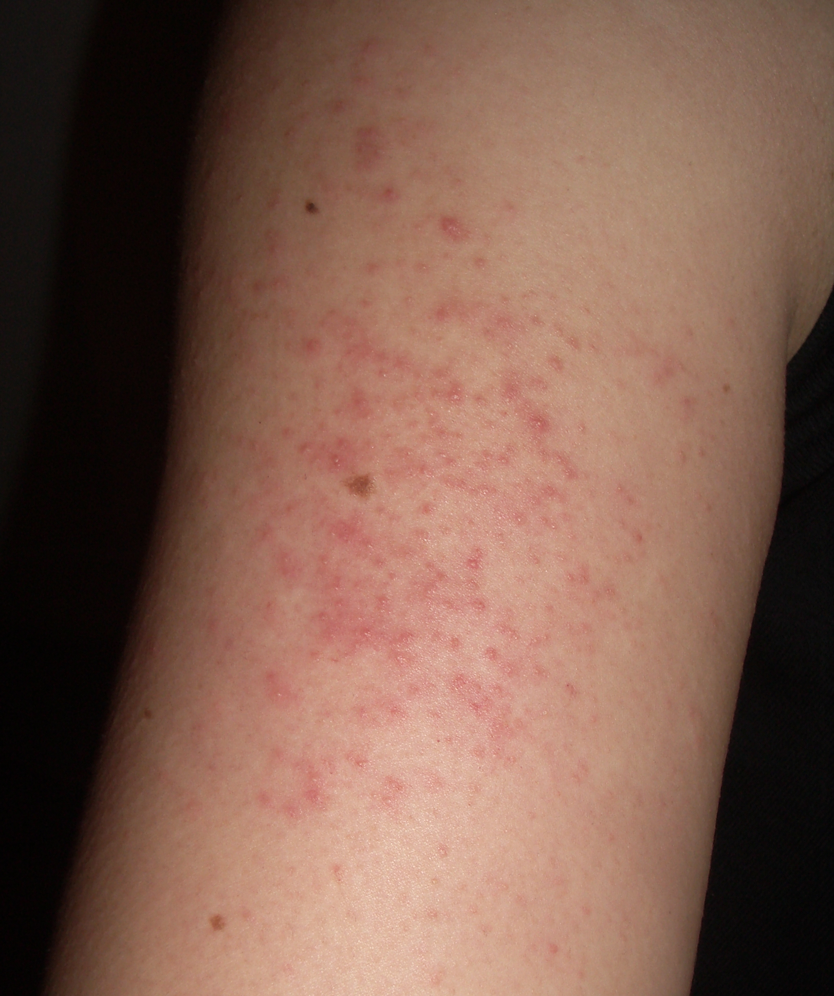 腕に赤い斑点が出来るのは病気 かゆみがある場合とない場合で分かる原因を知ろう Hapila ハピラ