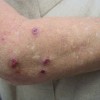 結節性痒疹とは？症状や原因、治療法や予防法を紹介！注意点はなに？