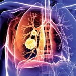 肺mac症とは？症状・原因・治療法・予防法を知ろう！結核との違いは？