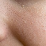 稗粒腫の取り方は？皮膚科で治療する方法を知ろう！症状や原因も紹介！