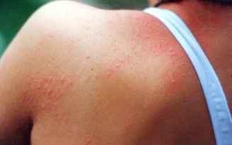 アレルギー 汗 異汗性湿疹（汗疱）と金属アレルギーについて