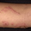 接触性皮膚炎とは？症状や原因、治療法や予防法を知っておこう！