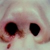 鼻前庭炎とは？症状や原因、治療法や予防法を紹介！鼻をほじる人は要注意！