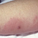 蜂巣炎とは？症状・原因・治療法・予防法を知っておこう！