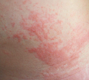 poison ivy rash treatment