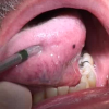 舌に血豆ができる８つの原因とは？治療法や対処法を紹介！