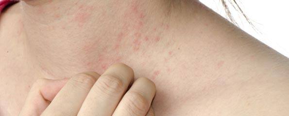 カポジ水痘状発疹の原因