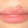 唇に膿が発生する原因は？病気かも？対処方法を知ろう！